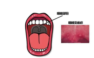 注意！注意！疱疹性咽峡炎进入高发季