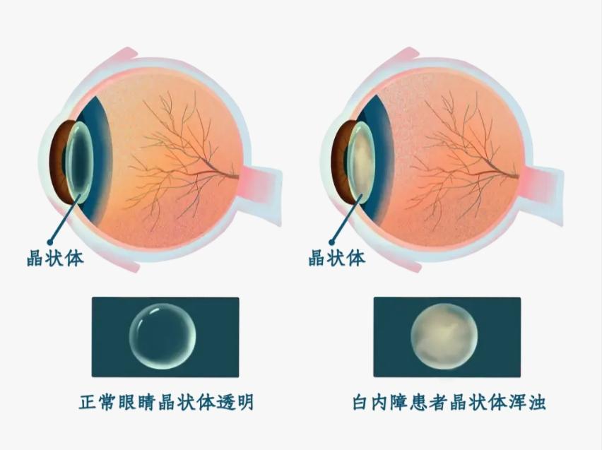 白內(nèi)障和老花眼？別擔心，這個方法可以解決......