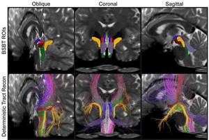 攻克脑成像技术难题&mdash;&mdash;AI算法自动解析脑干白质神经束